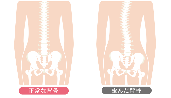 背骨のゆがみ